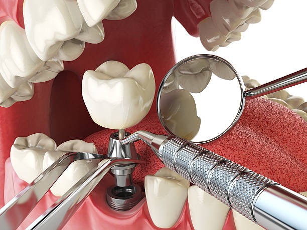 Best Emergency Wisdom Teeth Removal in Sandy Hook, CT